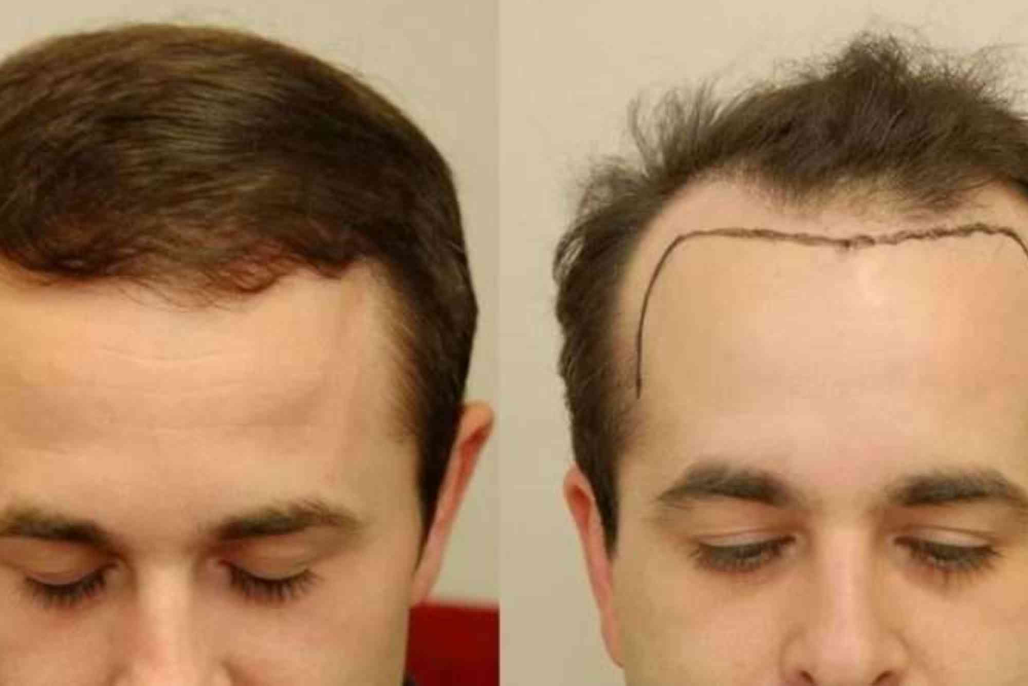 Best Hair Transplat Turkey